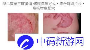 烫伤后皮肤发红没破皮没水疱哪种处理方法正确
